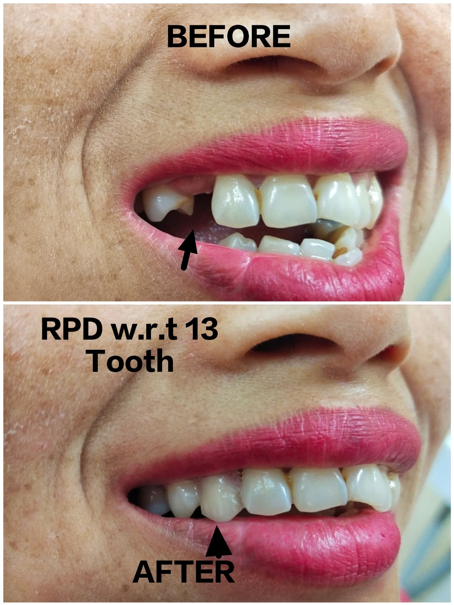 Before & After - Smile Transformation